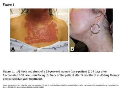 Figure 1 Figure 1. . . A) Neck and chest of a 53-year-old woman (case-patient 1) 14 days