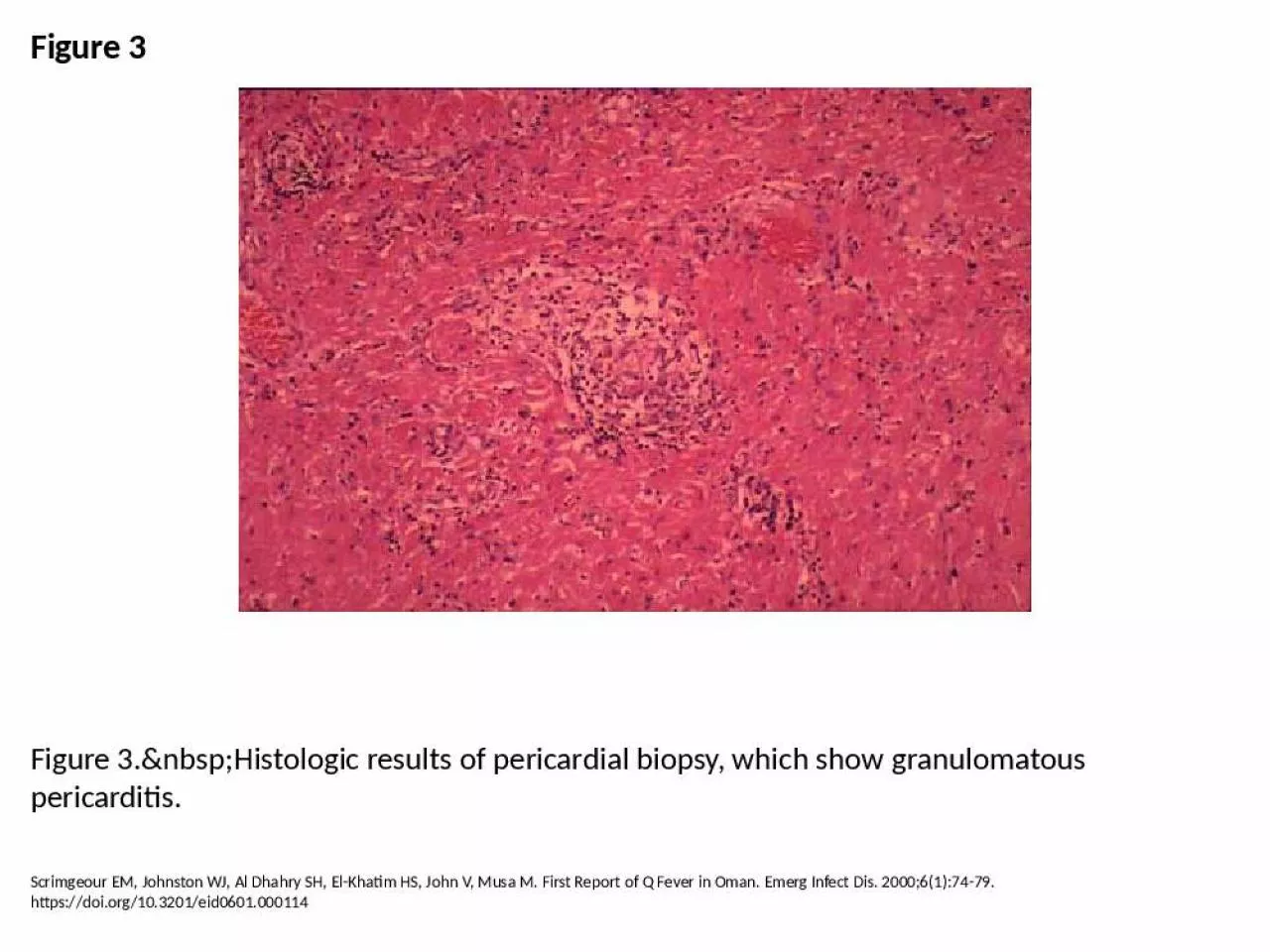 PPT-Figure 3 Figure 3.&nbsp;Histologic results of pericardial biopsy, which show granulomatous