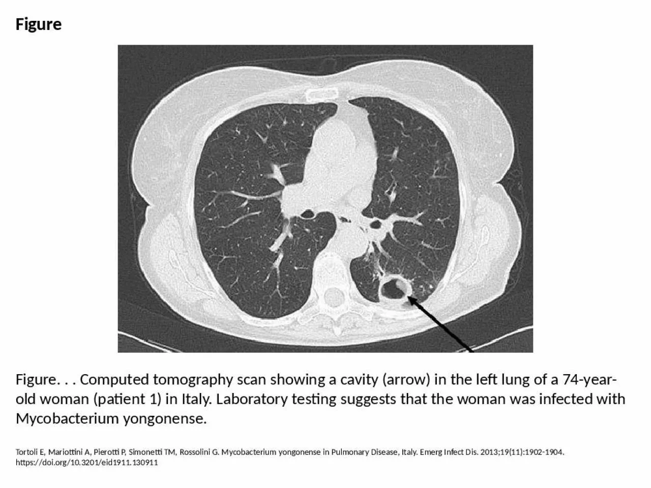 PPT-Figure Figure. . . Computed tomography scan showing a cavity (arrow) in the left lung