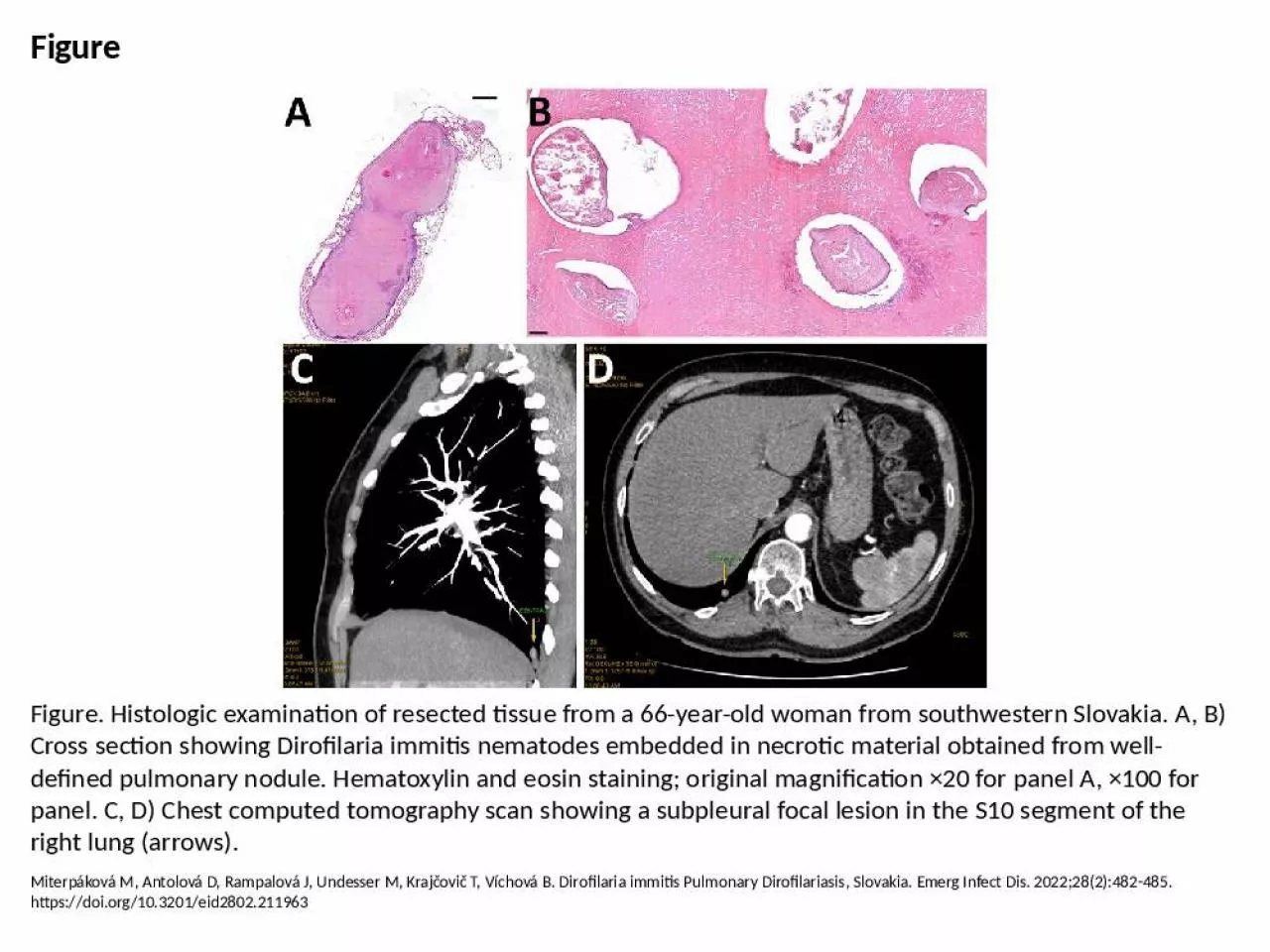 PPT-Figure Figure. Histologic examination of resected tissue from a 66-year-old woman from