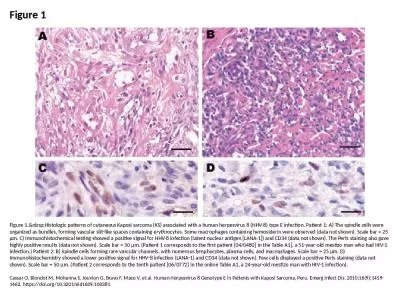 Figure 1 Figure 1.&nbsp;Histologic patterns of cutaneous Kaposi sarcoma (KS) associated