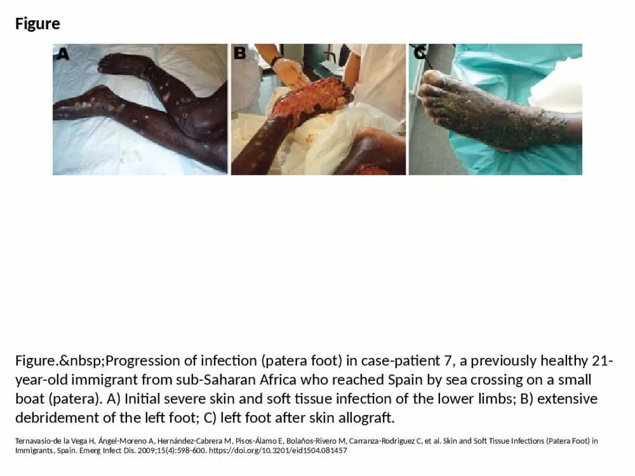 PPT-Figure Figure.&nbsp;Progression of infection (patera foot) in case-patient 7, a previously