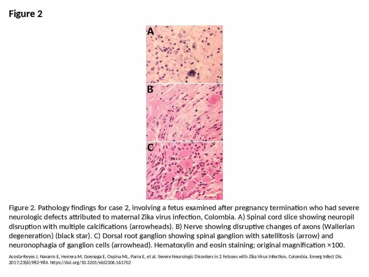 PPT-Figure 2 Figure 2. Pathology findings for case 2, involving a fetus examined after pregnancy