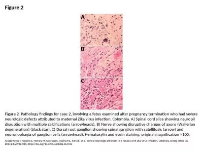 Figure 2 Figure 2. Pathology findings for case 2, involving a fetus examined after pregnancy termin