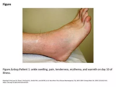 Figure Figure.&nbsp;Patient 1: ankle swelling, pain, tenderness, erythema, and warmth