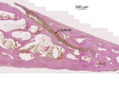 Suture Suture Bone Bone Bone