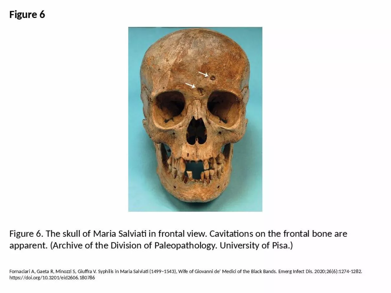 PPT-Figure 6 Figure 6. The skull of Maria Salviati in frontal view. Cavitations on the frontal