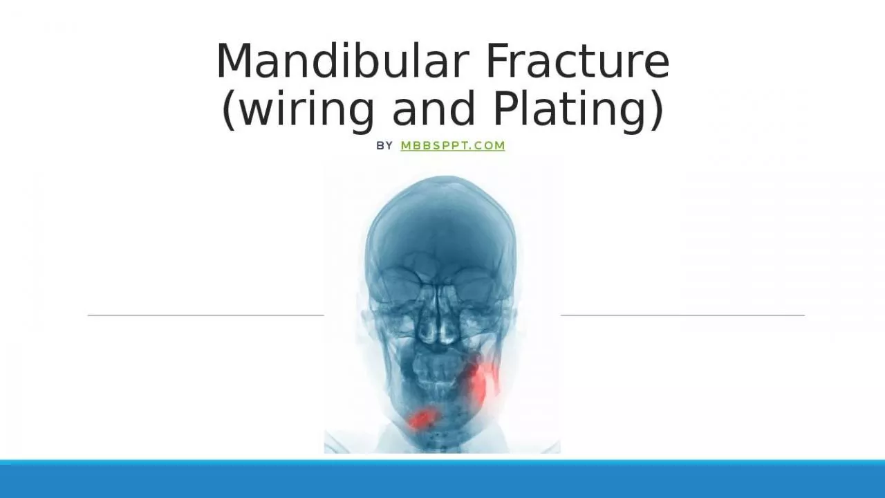 PPT-Mandibular Fracture (wiring and Plating)