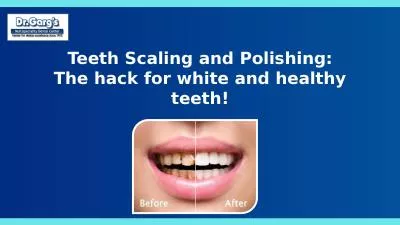 Teeth Scaling and Polishing: The hack for white and healthy teeth!