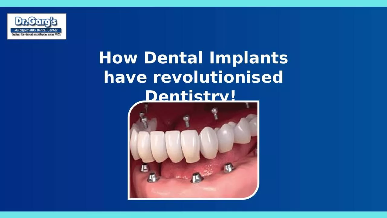 PPT-How Dental Implants have revolutionised Dentistry!