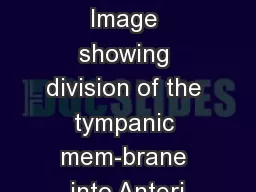 Figure 1. Image showing division of the tympanic mem-brane into Anteri