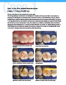This case study focuses on the restoration of an upper molar.