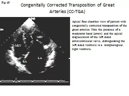 Congenitally Corrected Transposition of Great Arteries (CC-
