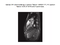 Cardiac MRI demonstrating LV ejection fraction 49%(57-77),