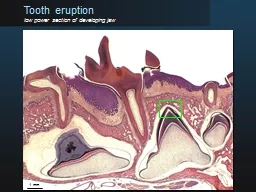 Tooth eruption