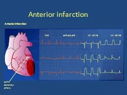 Anterior infarction