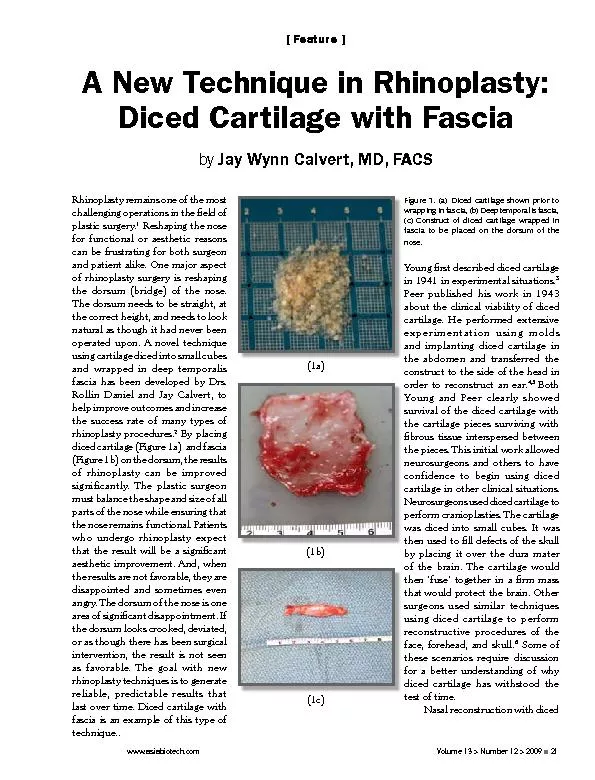 A new technique in rhinoplasty diced cartillage with fascia