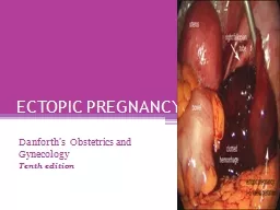 ECTOPIC PREGNANCY