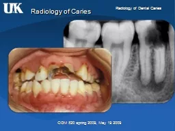 Radiology of Caries