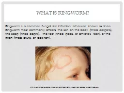 What Is Ringworm?
