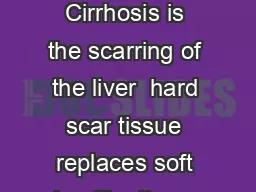 Facts AtAGlance  Cirrhosis is the scarring of the liver  hard scar tissue replaces soft