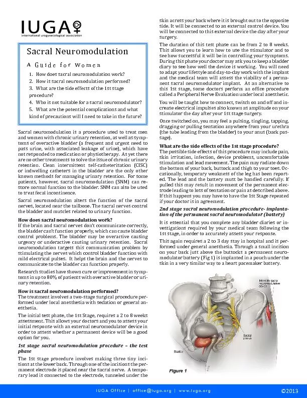 Sacral Neuromodulation
