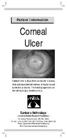 Patient Information Corneal Ulcer A defect in the surface of the cornea with a creamy