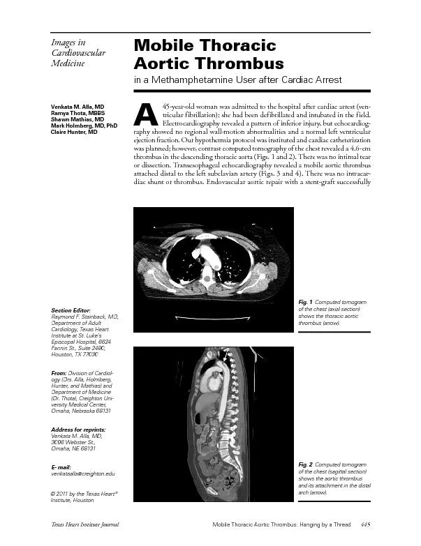 Texas Heart Institute JournalMobile Thoracic Aortic Thrombus: Hanging