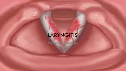 Laryngitis