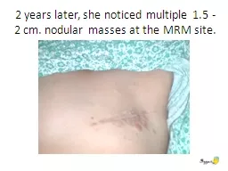 2 years later, she noticed multiple 1.5 -2 cm. nodular mass