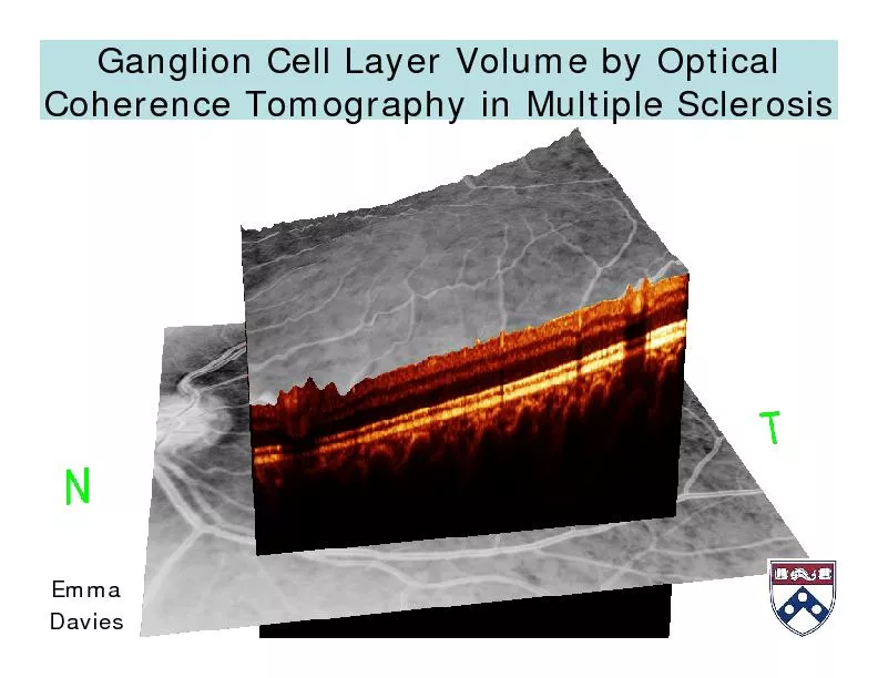 Ganglion Cell Layer Volume by Optical Coherence Tomography in Multiple