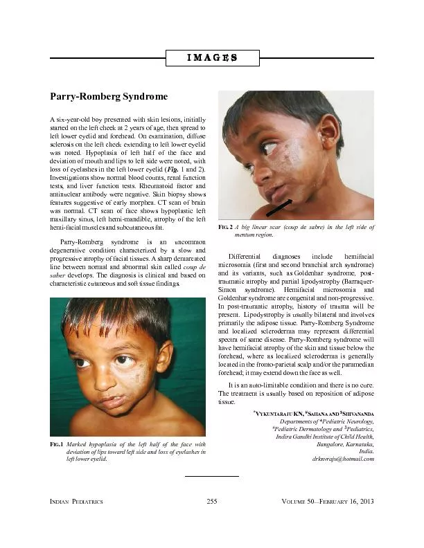 Parry-Romberg SyndromeA six-year-old boy presented with skin lesions,