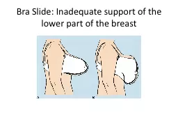 Bra Slide: Inadequate support of the lower part of the brea