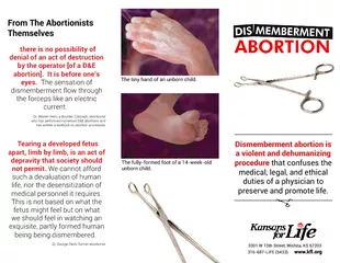 Dis memberment abortion