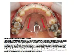 Biomechanics of Mini-Implant Placed in the Palate