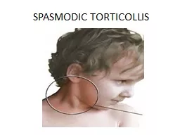 SPASMODIC TORTICOLLIS