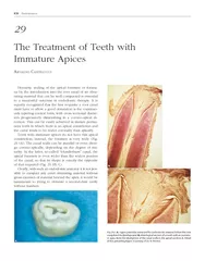 Endodontics Hermetic sealing of the apical foramen or