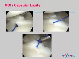 MDI / Capsular Laxity Throwing Shoulder