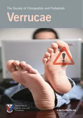 The Society of Chiropodists and Podiatrists Verrucae T