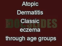 Atopic Dermatitis Classic eczema through age groups