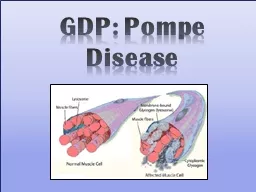 GDP: Pompe Disease http://www.fightpompe.com/about/21/about-juan