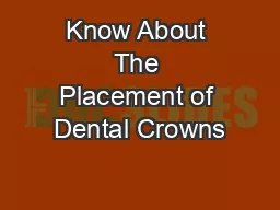 Know About The Placement of Dental Crowns