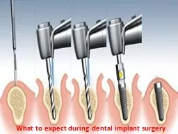 What to expect during dental implant surgery