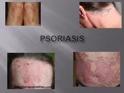  PSORIASIS What is Psoriasis?