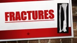 PPT-FRACTURES Closed and open fractures