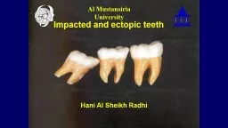 Impacted and ectopic teeth