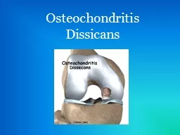 Osteochondritis   Dissicans