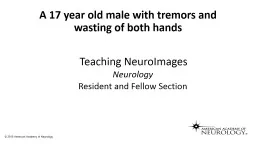 A 17 year old male with tremors and wasting of both hands