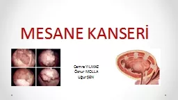 MESANE KANSERİ Cemre YILMAZ