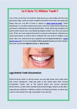 Is It Safe To Whiten Teeth?